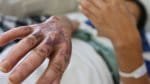 São João na Bahia registra 66 casos de queimaduras por fogos e fogueiras