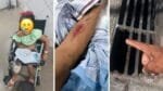 Criança leva 18 pontos ao cair em boca de lobo quebrada em Salvador